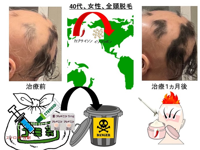 円形脱毛症　病院
